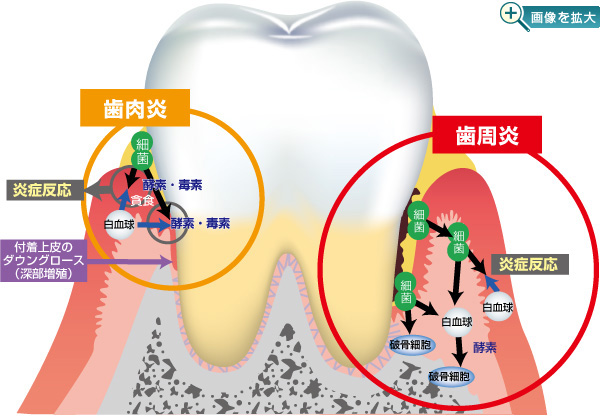 どうして歯周病になるの 歯周病のホームページ Mi21 Net