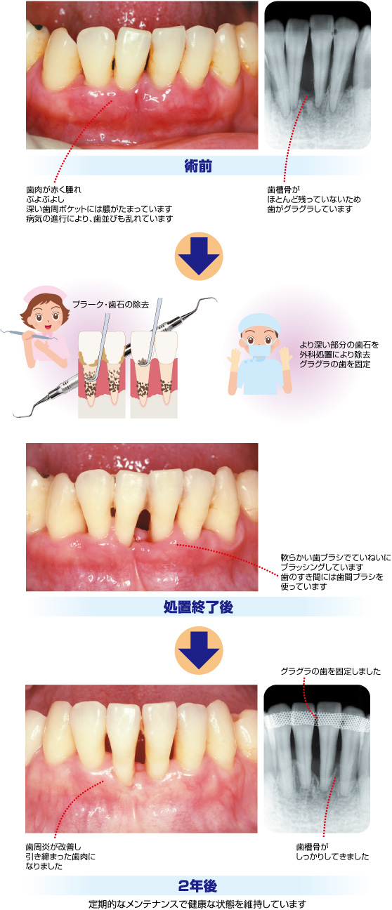 重度歯周炎の処置例